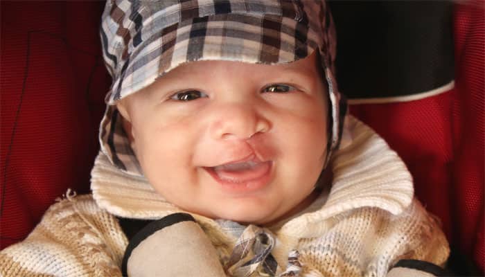 India sees 27,000 cleft lip cases per year