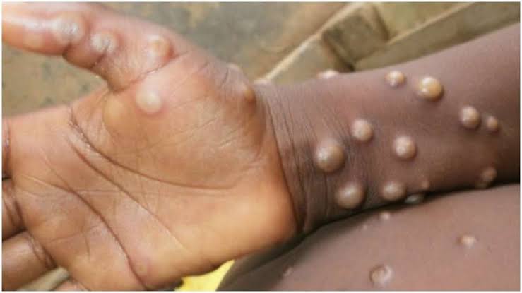 550 monkeypox cases confirmed, says UN
