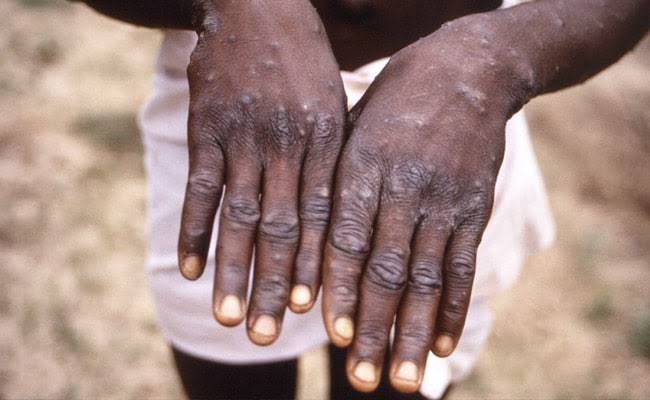Monkeypox: 104 new cases detected in UK
