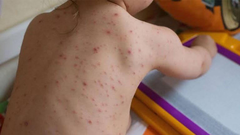 Chickenpox surge in Chennai: Children at risk amid summer heat