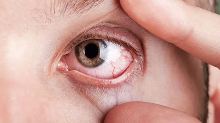 Rising dry eye cases in Chennai