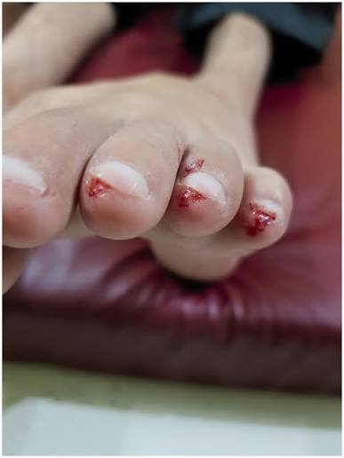 Woman’s toe damaged in alleged rat bite at Tiruchy GH