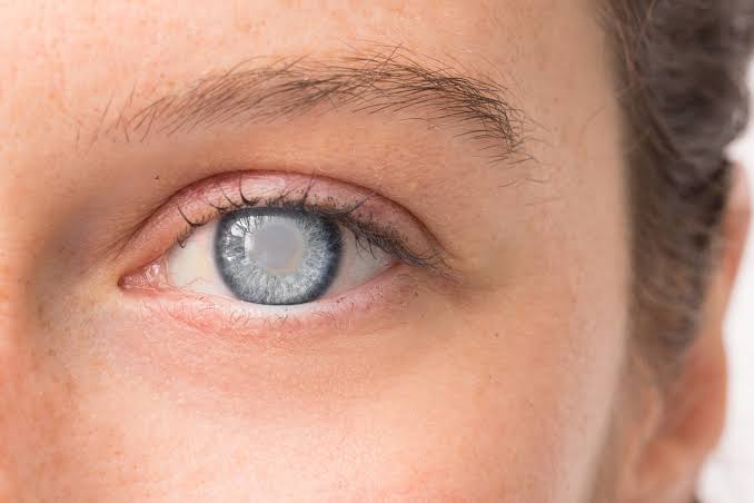 ‘Cataract cases on the rise’