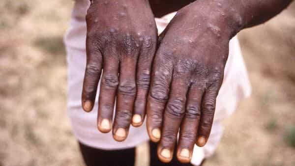 Monkeypox cases in UK pass 1,000