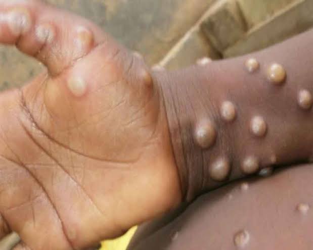 India sees first monkeypox death