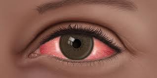 Know more about conjunctivitis