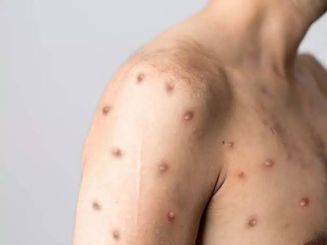 TNIID debunks chickenpox vaccination claim
